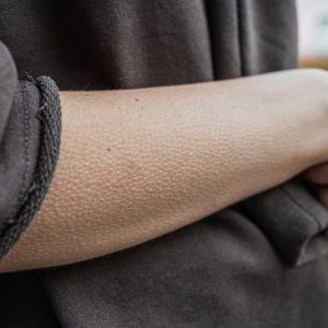 ce-este,-de-fapt,-pielea-de-gaina.-de-ce-ti-se-intampla-si-ce-spune-despre-corpul-tau