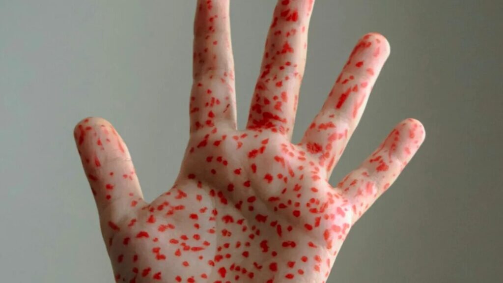 Epidemia de rujeolă din SUA cauzează decese la copii nesupravegheați de vaccin